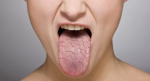 Những bệnh như viêm thấp khớp, luput hoặc viêm mạch máu cũng có thể dẫn đến hội chứng Sjögren thứ phát khiến hệ miễn dịch tấn công vào các tuyến nước mắt và nước bọt gây khô mắt và khô miệng. 