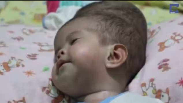 Thống kê cho thấy trong nhiều năm qua, tỉ lệ tử vong khi phẫu thuật tách rời các bé song sinh bị dính liền phụ thuộc vào tình trạng dính liền cũng như cơ quan nội tạng mà các bé phải chia sẻ. Chưa hề có cặp song sinh dính liền ở phần ngực và có chung tim nào sống sót được sau ca phẫu thuật. Mặc dù tỉ lệ thành công trong vài năm qua đã tăng lên một chút nhưng vẫn thấp.