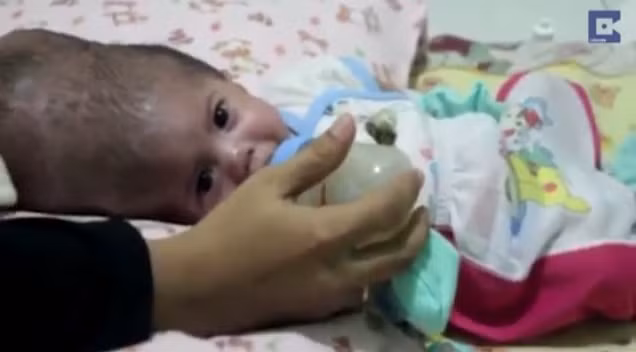 Tuy nhiên việc mổ tách rời hai bé bị dính liền hộp sọ hiện nay là rất khó khăn vì các bé vẫn còn quá nhỏ. Để có thể sống sót được sau ca phẫu thuật, mỗi bé cần cân nặng ít nhất 10kg. Trường hợp đặc biệt này đã được chuyển lên một bệnh viện trung ương của Indonesia nhưng vì đây là ca mổ phức tạp đòi hỏi độ chính xác và tay nghề cao nên cha mẹ của hai bé vẫn cần phải đợi thêm ít nhất từ 6-8 tháng nữa cho đến khi hai bé đủ trọng lượng vì đây là một quyết định không thể xem thường. 