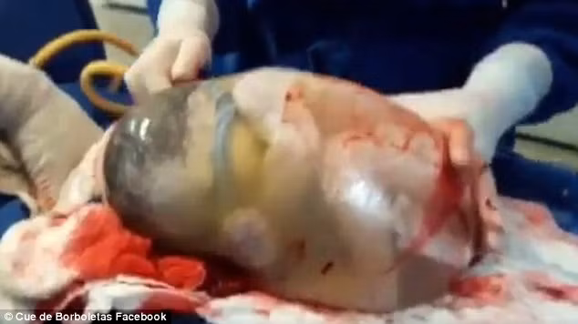 Can canh thai nhi sinh ra trong boc oi hiem gap