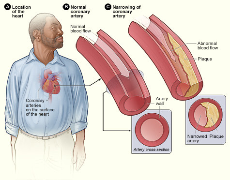 Nhân tố đầu tiên ảnh hưởng đến lượng cholesterol trong cơ thể là gien. Nếu gia đình có người bị đau tim khi vẫn còn trẻ, tức dưới 40 tuổi hay đột quỵ trước 65 tuổi thì khả năng là do di truyền. 