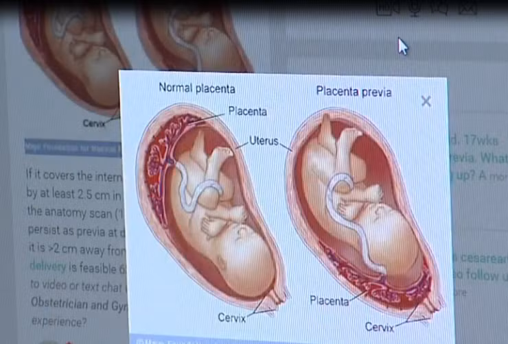 Bác sĩ Melissa Dennis, giám đốc bệnh nơi Emily sinh con giải thích rằng tình trạng hiếm gặp này chỉ xảy ra với tỉ lệ dưới 1%. “Khi bị nhau thai tiền đạo, phụ nữ bị xuất huyết âm đạo nhưng hông cảm thấy đau đớn nên chỉ nghĩ đó là một kỳ kinh bình thường”. 