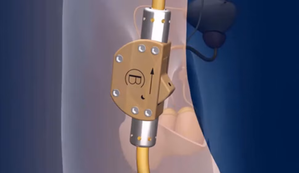 Một người thợ mộc ở Đức đã giành thời gian tới 20 năm để chế tạo ra một dụng cụ tránh thai cho đàn ông. Dụng cụ này thực ra là một chiếc công tắc có kích cỡ bằng một viên kẹo nhỏ được gắn trên ống dẫn tinh của đàn ông. Hơn nữa, dụng cụ tránh thai độc đáo này còn có công tắc bật tắt. 