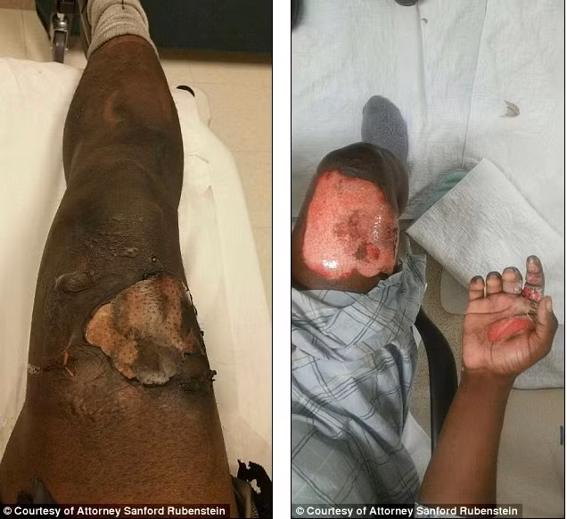 Bức ảnh này cho thấy phần da đùi của anh Otis đã bị cháy xém khiến thịt hở ra, bàn tay cũng xám đen vì cháy khi cố gắng lấy dụng cụ kia ra khỏi túi quần. 