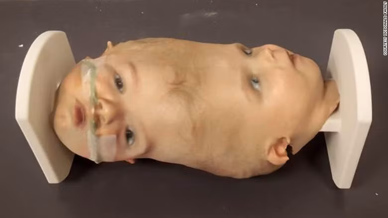 Một tuần trước khi phẫu thuật, đội ngũ bác sĩ đã thực hành rất nhiều trên mô hình 3D.