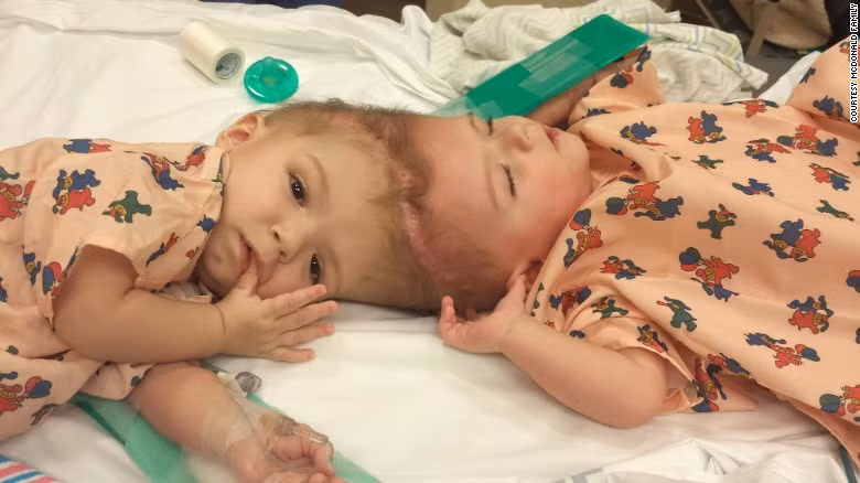 Nếu ca phẫu thuật thành công, coi như hai bé được sinh ra lần thứ hai và bắt đầu học đi, học ngồi từ đầu.