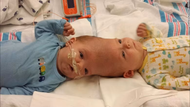 Ca tach roi trieu do cho cap sinh doi dinh lien dau