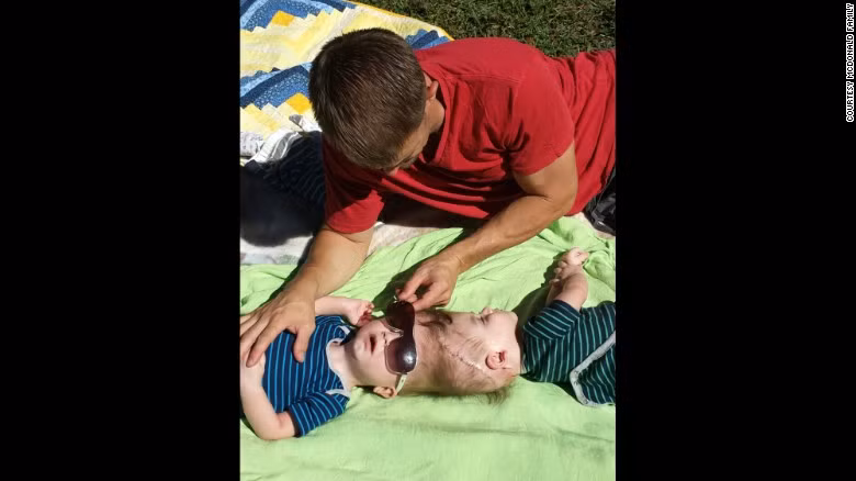 Anias và Jadon McDonald chào đời vào tháng 9/2015 gần Chicago (Mỹ) và bị dính nhau ở phần chỏm đầu. 