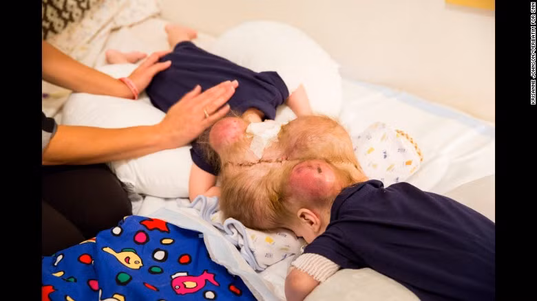 Vì vậy, sống được tới hiện nay cũng đã là kỳ tích đối với hai cậu bé nhà McDonald vì hai bé bị dính khoảng 5cm chu vi tế bào não nên ca phẫu thuật tách rời cũng sẽ có những nguy cơ rất lớn như cả hai bé sẽ không qua khỏi hoặc qua khỏi nhưng 1 trong 2 hoặc cả 2 bé sẽ bị ảnh hưởng đến não. 