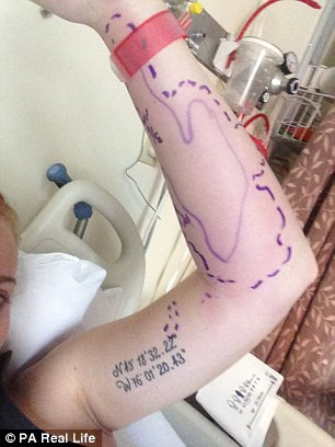 Tại một trung tâm y tế, các bác sĩ cho biết cô bị viêm tế bào gây nhiễm trùng tới lớp da và tế bào bên dưới. Các bác sĩ chỉ kê cho cô một số loại kháng sinh đồng thời dùng bút khoanh vùng vùng da tấy đỏ và dặn cô nếu vết bầm tiếp tục lan rộng hơn thì cần đến bệnh viện ngay lập tức.