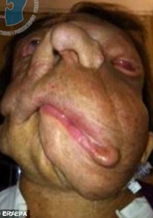 Xuất hiện trong một buổi họp báo với một khuôn mặt với một vết sẹo dài ngang mặt và cổ nhưng trông khá thoải mái, danh tính của người phụ nữ này đã được xác định chính là Joana, người Ba Lan thứ hai được cấy ghép mặt sau khi bị u sợi thần kinh – một rối loạn về gien tuy chỉ gây các u lành trên mặt nhưng khiến người bệnh không nhai, nuốt và nói được. 