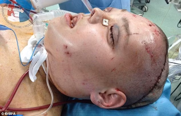 Bệnh u sợi thần kinh thường gây ảnh hưởng đến xương, gây áp lực lên thần kinh cột sống khiến người bệnh đau đớn nặng nề, ngoài ra còn ảnh hưởng đến thị lực và thính lực. Mặc dù nhiều người mắc bệnh này do di truyền nhưng 50% là bị lỗi gien bẩm sinh. 