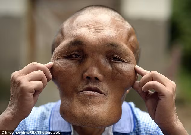 Gia đình của người đàn ông có khuôn mặt biến dạng này hy vọng anh có thể quyên góp đủ tiền để có thể phẫu thuật mặt nhằm thay đổi ngoại hình như người ngoài hành tinh hiện nay. 