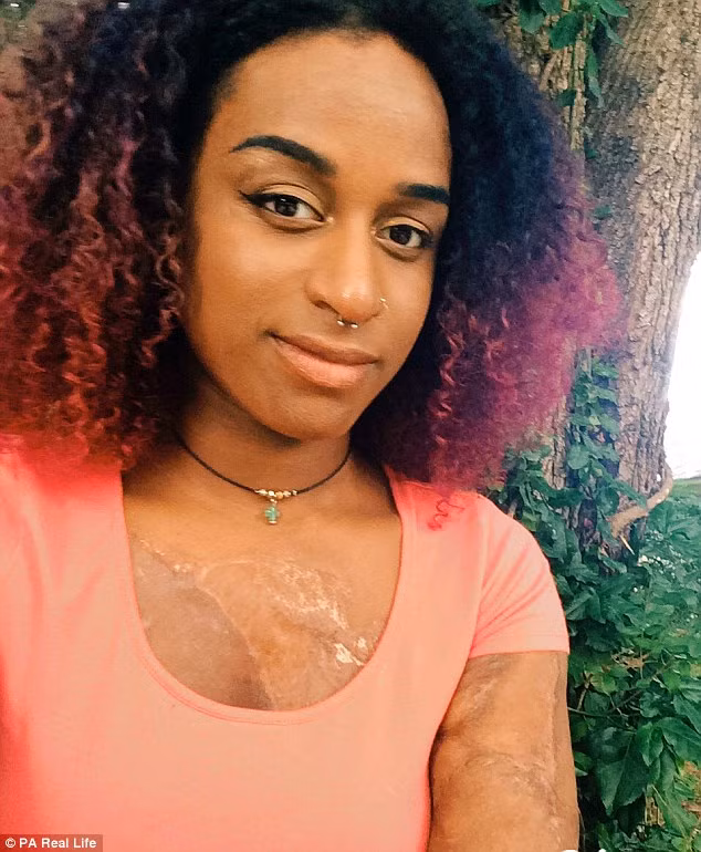 Ban đầu khi nhìn vào phần da vá trên ngực bị tối màu hơn da thật của mình, Alexandra thấy hơi kỳ quặc nhưng rất may là cơ thể cô không đào thải phần da cấy ghép này. Cô quen dần và chỉ nghĩ đến nó khi có người hỏi. 