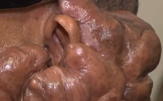 Crowell đã buộc phải sống trong tình trạng này trong hơn 10 năm qua sau 2 lần phẫu thuật cắt bỏ phần sẹo trâu với 15kg da thừa. Nhưng sau khi cắt thì vết sẹo còn lồi lên khủng khiếp hơn. 