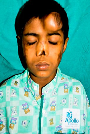 Một cậu bé 12 tuổi người Ấn Độ bị mất mũi đã được “trồng” một cái mũi mới ở trên trán nhờ một quá trình đặc biệt. Arun Patel, tên cậu bé, đã bị mất mũi vì tác dụng phụ của một loại thuốc tiêm dưới tay nghề của một bác sĩ "lang băm" từ lúc 1 tháng tuổi khiến các tế bào mũi bị co lại và chết đi.