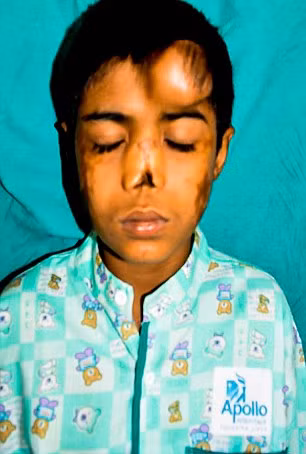 Một cậu bé 12 tuổi người Ấn Độ bị mất mũi đã được “trồng” một cái mũi mới ở trên trán nhờ một quá trình đặc biệt. Arun Patel, tên cậu bé, đã bị mất mũi vì tác dụng phụ của một loại thuốc tiêm dưới tay nghề của một bác sĩ "lang băm" từ lúc 1 tháng tuổi khiến các tế bào mũi bị co lại và chết đi.