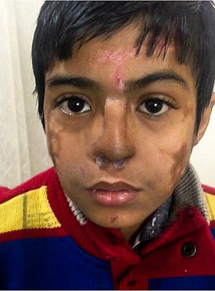 Về phía Arun, cậu bé rất vui mừng vì chiếc mũi mới không chỉ mang lại cho cậu bé diện mạo mới mà còn mang lại cho cậu một cuộc sống hoàn toàn mới, không còn bị bạn bè trêu trọc hay tỏ ra ghê sợ. 