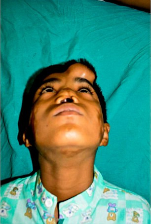 Một ca phẫu thuật thẩm mỹ bất thường đã thực hiện cấy mũi nhân tạo lên trán cậu bé để nuôi trước khi gắn vào làm mũi thật. Bác sĩ Dr Ashwini Das, trưởng ca phẫu thuật cho biết quá trình này trải qua 4 giai đoạn và kéo dài khoảng 1 năm. 