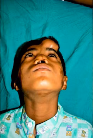 Một ca phẫu thuật thẩm mỹ bất thường đã thực hiện cấy mũi nhân tạo lên trán cậu bé để nuôi trước khi gắn vào làm mũi thật. Bác sĩ Dr Ashwini Das, trưởng ca phẫu thuật cho biết quá trình này trải qua 4 giai đoạn và kéo dài khoảng 1 năm. 