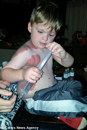 Cậu bé Dylan đã rất dũng cảm khi phải phẫu thuật quá nhiều khi còn quá nhỏ nhưng lúc nào cũng tươi cười.