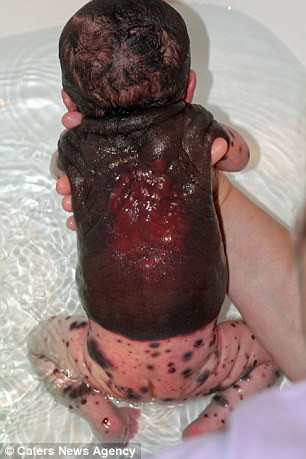 Dylan Little được sinh ra tại Georgia (Mỹ) với bớt sắc tố bẩm sinh khiến nốt ruồi mọc khắp nơi trên người, trong đó “nốt” to nhất kéo dài từ trên tai cho đến tận mông khiến lưng đen sì như da trâu và chảy máu, những nốt khác có kích thước khác nhau từ chấm nhỏ đến nửa đồng polyme. 