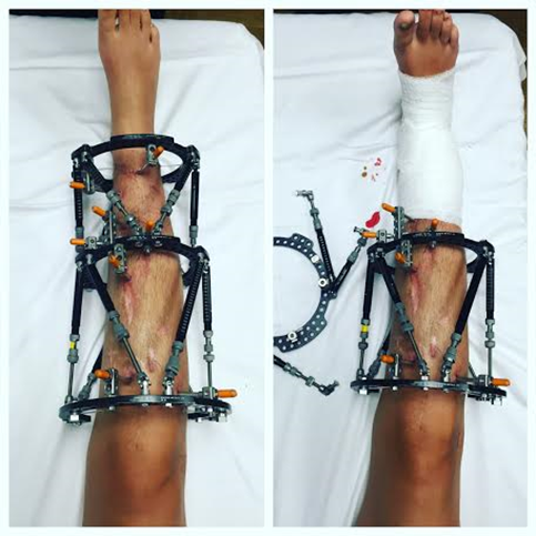 Thieu nu chap nhan cua chan de keo dai chan vi tai nan-Hinh-2