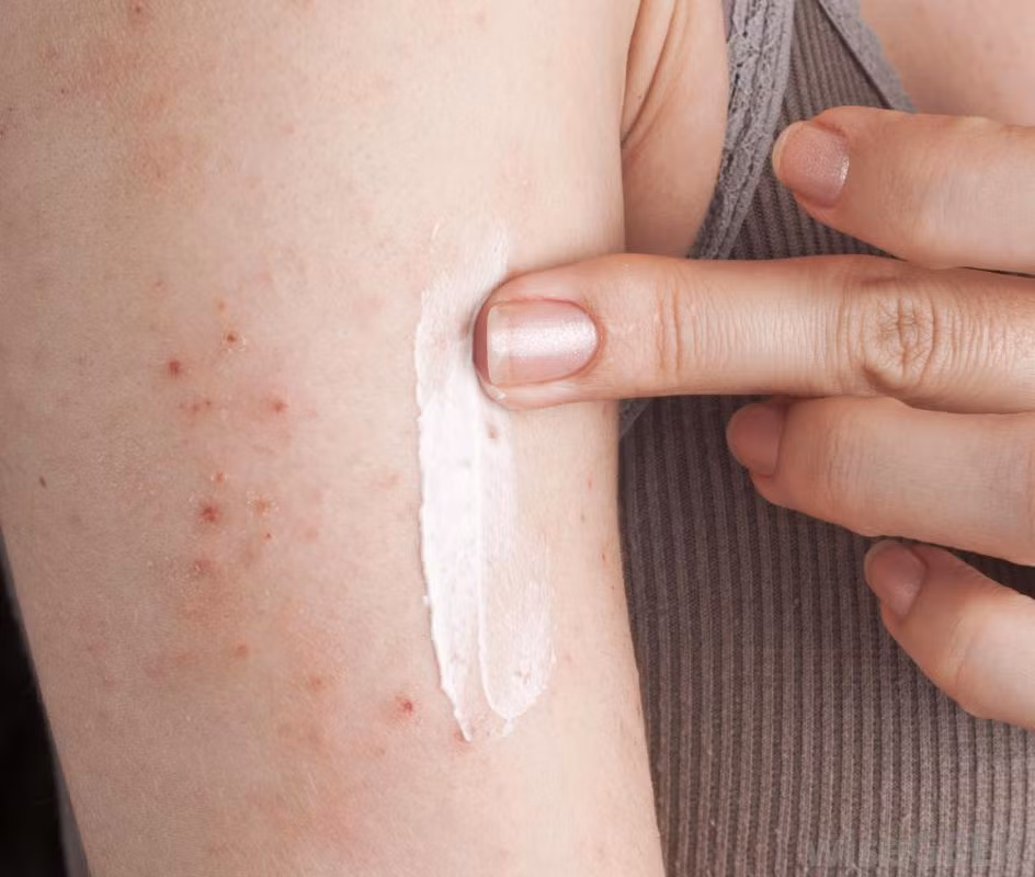 Nếu kiểm tra bằng mắt thường không phát hiện điều gì nhưng khi bôi kem chống nắng lên da bạn cảm thấy da bị kích ứng hoặc mẩn ngứa thì nên thay ngay kem chống nắng khác. 