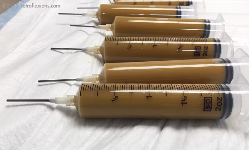 Liệu pháp vi khuẩn chất thải, hay còn gọi là cấy ghép phân người có nghĩa là chuyển một mẫu "chất thải" từ một người cho khỏe mạnh sang người nhận. Phương pháp dùng vi khuẩn từ phân người này được thực hiện qua một ống thông luồn qua mũi xuống dạ dày hoặc xuống thẳng tới ruột kết. (Ảnh: Kevin MD) 