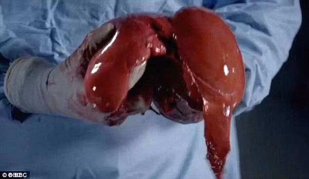 Lá gan là bộ phận thể hiện rõ nhất về chế độ ăn uống. Lá gan của người khỏe mạnh có màu đỏ sẫm và bề mặt láng mịn. Nhưng lá gan của người béo phì có thể to hơn, mềm hơn hoặc sứt sẹo. Lá gan của bệnh nhân này to hơn bình thường khoảng 30%, một dấu hiệu của bệnh gan nhiễm mỡ do béo phì. Những tế bào mỡ trên gan đã chuyển từ màu đỏ thành màu hồng nhạt. 