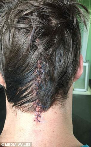 Bác sĩ thần kinh riêng của Tom sau đó phát hiện anh đĩa thị giác trong mắt của anh bị sưng, một dấu hiệu cho thấy não bị chèn ép. Xét nghiệm thêm một lần nữa mới xác định chính xác anh bị một khối u hình chữ nhật dài 6cm trong khoang chứa chất lỏng ở phần não sau. 