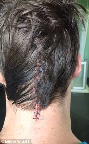 Bác sĩ thần kinh riêng của Tom sau đó phát hiện anh đĩa thị giác trong mắt của anh bị sưng, một dấu hiệu cho thấy não bị chèn ép. Xét nghiệm thêm một lần nữa mới xác định chính xác anh bị một khối u hình chữ nhật dài 6cm trong khoang chứa chất lỏng ở phần não sau. 