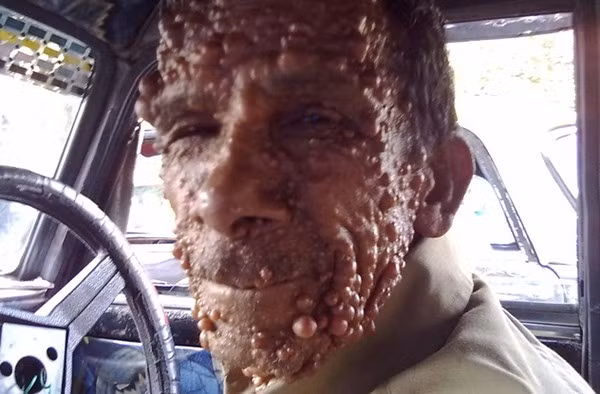 Mặc cho căn bệnh hiếm gặp tấn công mình, Tina vẫn không vì thế mà né tránh mọi người. Cô vẫn tích cực giao lưu với bạn bè và tìm thấy niềm đam mê trong chạy bộ. Đây cũng chính là điều giúp cho cô không còn nghĩ đến căn bệnh quái ác này nữa. (Nguồn ảnh: Dailymail)