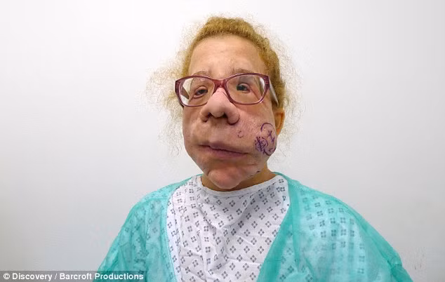 Một sinh viên người Slovenia bị mọc một khối u trên mặt từ khi còn nhỏ đã trải qua ca phẫu thuật lần thứ 12 với hy vọng các khối u vĩnh viễn không quay trở lại. 