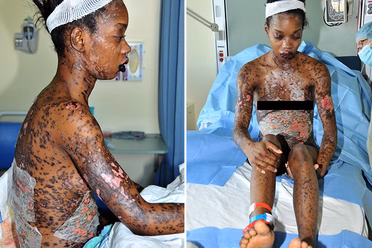 Các bác sĩ vô cùng bối rối không biết chuyện gì đang xảy ra, thời điểm đó Sandy mới đi Morocco về nên và có tiếp xúc với khỉ ở bên đó nên các bác sĩ cho rằng cô đang bị nhiễm virus herpes vì các triệu chứng bên ngoài rất giống. Mọi chuyện diễn ra rất xấu và bác sĩ tiên lượng cô khó qua khỏi. 