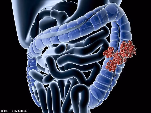 Ngủ quá ít có liên quan đến ung thư: Ngoài ảnh hưởng xấu đến sức khỏe như béo phì, căng thẳng quá mức và tiểu đường thì nguy cơ ung thư vú ở phụ nữ ngủ quá ít bị tăng lên tới 60% vì cơ thể không sản sinh đủ melatonin. 