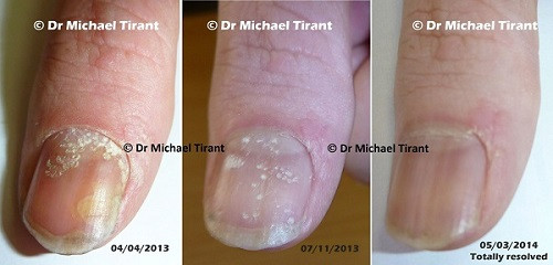 Nguyên nhân lây lan bệnh nấm móng có thể là do tiếp xúc với người bị nấm móng hoặc bị lây từ các vật dụng hay dùng cho móng như kìm cắt móng, bấm móng, dũa móng. Ngoài ra, bạn cũng rất dễ bị nấm chân khi trời mưa vì chân bị ngâm trong nước bẩn. 