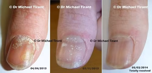 Nguyên nhân lây lan bệnh nấm móng có thể là do tiếp xúc với người bị nấm móng hoặc bị lây từ các vật dụng hay dùng cho móng như kìm cắt móng, bấm móng, dũa móng. Ngoài ra, bạn cũng rất dễ bị nấm chân khi trời mưa vì chân bị ngâm trong nước bẩn. 