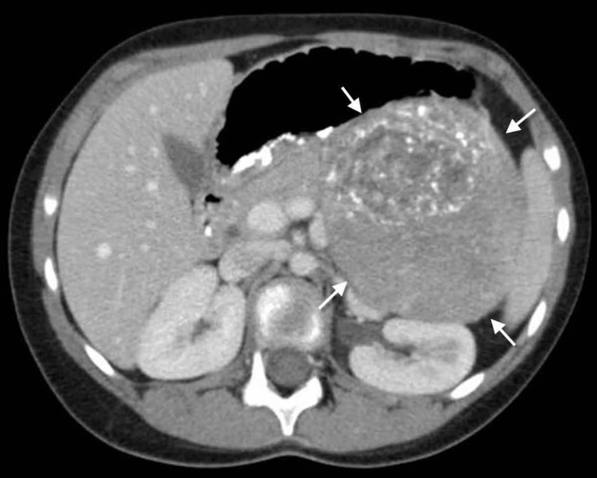 U nguyên bào thần kinh là một dạng ung thư hiếm gặp ở trẻ em, thường xuất hiện ở một trong hai tuyến thượng thận trong bụng hoặc trong các tế bào thần kinh chạy dọc theo xương sống. Ung thư có thể di căn đến các tế bào xung quanh như tủy, xương, bạch huyết, gan và da. Bệnh thường được phát hiện ở trẻ nhỏ dưới 5 tuổi nhưng phần lớn đều không xác định được nguyên nhân. 