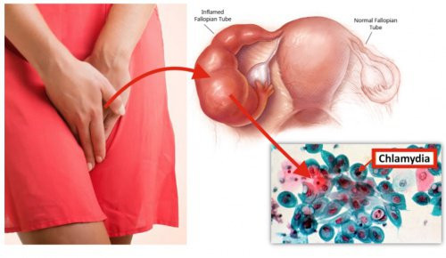 Nấm chlamydia là một dạng viêm do vi khuẩn khác do quan hệ không an toàn. Cũng giống như lậu, bệnh này hoàn toàn có thể phòng ngừa được nếu sử dụng bao cao su. 