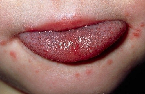 Bao cao su có thể bảo vệ bạn khỏi herpes nhưng không triệt để mà chỉ được 80%. Một phần là do virus herpes có thể sống trên những vùng da không được bao cao su bảo vệ. Khoảng 70% số nhiễm herpes không có triệu chứng, nếu có thì là phồng rộp hoặc nổi u, nóng rát hoặc ngứa ngáy. Khi mới bị nhiễm, một số bệnh nhân có thể sốt, lạnh, nổi hạch, đau đầu hoặc mệt mỏi. Hiện chưa có thuốc trị herpes mà chỉ có thuốc kháng virus để làm giảm các triệu chứng. 