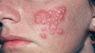 Quan hệ làm herpes lây lan từ miệng người này sang người khác và ngược lại. Bệnh có thể lây khi người bệnh không hề có dấu hiệu bị bệnh. 