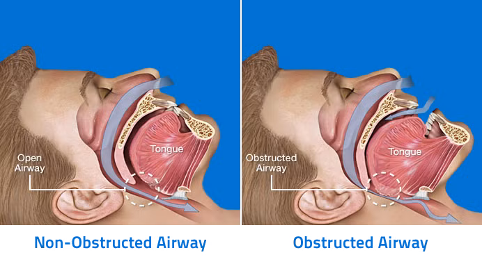 Chứng ngưng thở khi ngủ được hiểu là tình trạng cơ thể ngừng thở trong một khoảng thời gian trong khi đang ngủ, có thể vài lần trong một tối. Nguyên nhân là do có một vật cản sinh lý nào đó phía sau cổ họng, hoặc do hệ thần kinh và cơ không hoạt động đồng nhất với nhau, hoặc do cả hai.