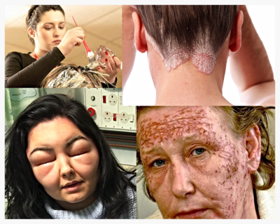 PPD còn gây dị ứng da. Một khi đã bị dị ứng, chỉ tiếp xúc với một lượng nhỏ PPD là da đã bị mẩn ngứa, thậm chí nhiều trường hợp nặng còn gây tử vong. 