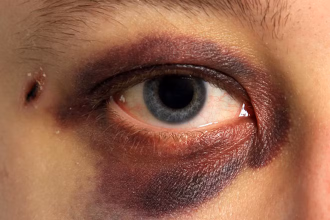 Khi trẻ bị thương ở mắt dẫn đến chảy nước mắt liên tục, nhạy cảm với ánh sáng hoặc nhìn mờ thì dùng khăn ẩm và mát đắp lên mắt rồi đưa trẻ đi cấp cứu. Nếu đó chỉ là vết xước thì chỉ cần bôi thuốc là vết thương sẽ lành lại trong khoảng 1-2 ngày. Nhưng nếu là hóa chất dính vào mắt thì giữ không cho trẻ nhắm mắt rồi đưa trẻ đi cấp cứu ngay. 