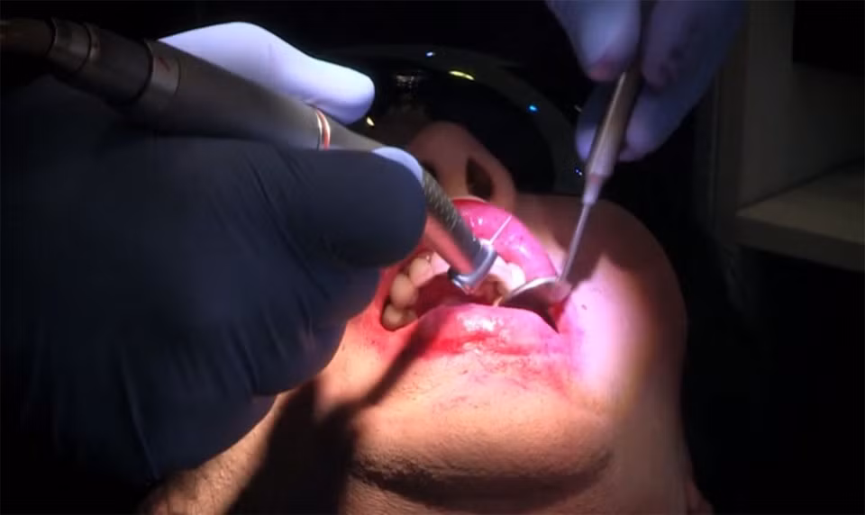 Đã rất gần cái chết, Pete được tiêm thuốc làm tan máu và sau 10 ngày khổ sở thì qua khỏi. Nhưng thuốc làm tan máu này lại dẫn đến loãng xương, rụng răng, hư hại cột sống và hàng loạt những vấn đề rắc rối khác. 