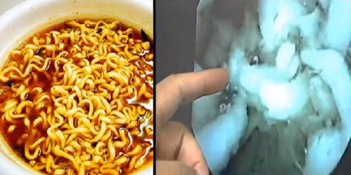 Những hình ảnh thu được qua camera cho thấy bộ phận tiêu hóa bên trong cơ thể đã phải làm việc khá vất vả để tiêu hóa loại thức ăn này. 