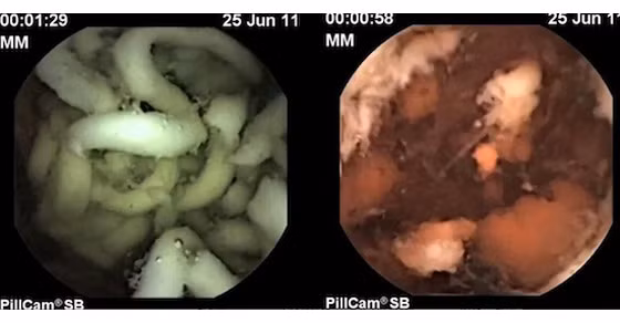Đây là hình ảnh sau khi ăn 20 phút. So với một loại thực phẩm chế biến tại nhà, sau 20 phút, sợi mì tôm vẫn còn nguyên hình dạng. 