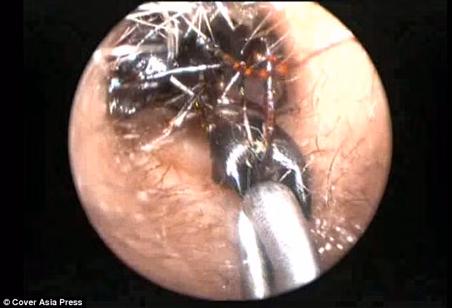 “Gia đình cô bé thì cho biết mặc dù bị kiến cắn nhưng cô bé không hề thấy đau và ống màng nhĩ cũng không hề bị hư hại gì. Gia đình sống trong môi trường hoàn toàn bình thường và sạch sẽ nên loại trừ nguyên nhân kiến chui vào tai do điều kiện sống” - bác sĩ cho biết.