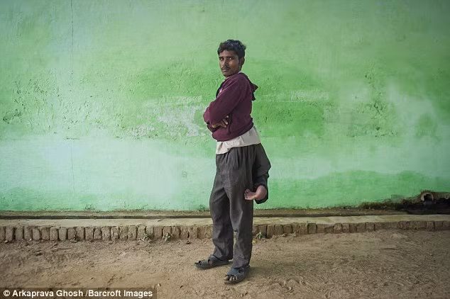 Arun Kumar năm nay 22 tuổi hiện sống tại Uttar Pradesh (Ấn Độ) bẩm sinh đã có 2 chân thừa ở phần lưng dưới phía sau, trong đó có một chân phát triển chưa đầy đủ, còn một chân thì vĩnh viễn lòng thòng ở đầu gối. 